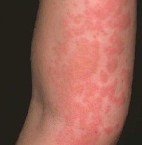 кожная аллергия