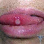 Прищі на язиці ближче до горла: фото і причини