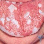 Прищі на язиці ближче до горла: фото і причини