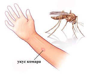 аллергия от укуса комара