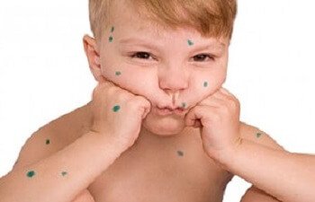 Детские инфекционные заболевания