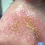 Себорейный дерматит: проявление болезни на лице, лечение