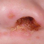 стрептодермия у детей в носу
