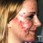 угри на лице у девушки - симптомы и лечение