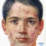 Угри на лице: основные симптомы высыпания