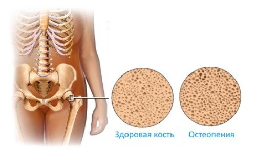 osteopenia