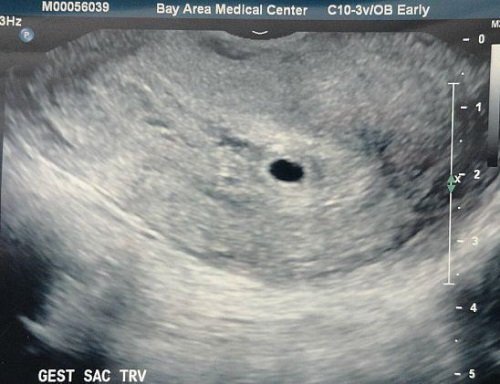 Беременность 4 недели видна на узи. Как выглядит зародыш в 3-4 недели на УЗИ. Плод 3-4 недели беременности на УЗИ. Эмбрион на 4 неделе беременности УЗИ. 4 Недели беременности фото плода на УЗИ.