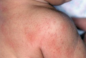 Аллергическая сыпь на спине ребенка явление частое