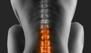 Сдавливание нервных корешков спинного мозга приводит к компрессионному синдрому 