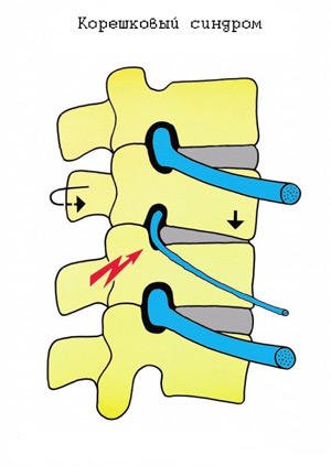 Симптомом корешкового синдрома шейного отдела является боль по ходу нервных волокон