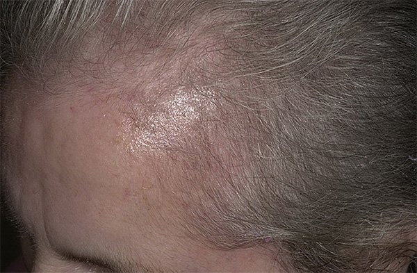 Диффузное телогеновое выпадение волос
