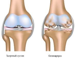 Osteoartroz-kolena