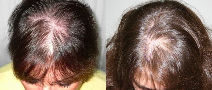 Причини і лікування сильного випадання волосся