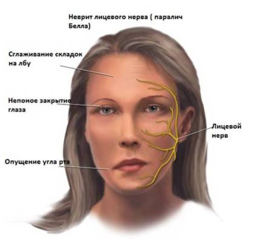 Наиболее распространенная форма - неврит лицевого нерва