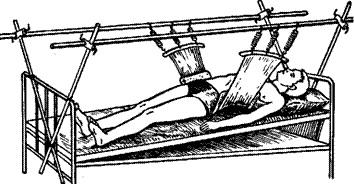 Постоянное вытяжение по Звереву-Ключевскому при лечении компрессионных переломов нижних грудных и поясничных позвонков