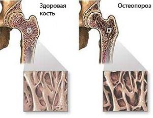 Чтобы обнаружить остеопороз, обратитесь к врачу за консультацией