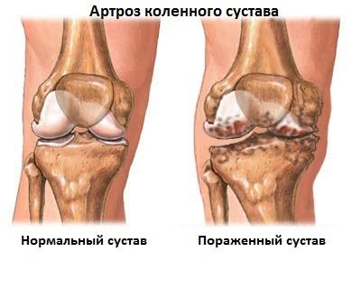Гонартроз коленного сустава 2 степени фото