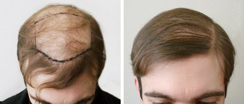 Пересадка волос — самый радикальный способ избавиться от лысины