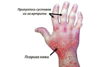 artrit-psoriaz
