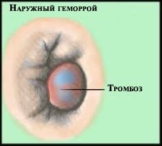 Образование тромбов при геморрое