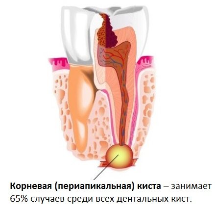 Зубная корневая (периапикальная) киста