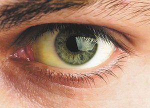 жёлтые белки глаз при желтухе