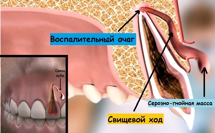 Свищ зуба на десне – вид спереди и сбоку