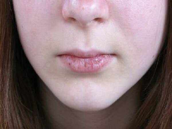 Хейліт на губах–що це таке, який буває і як лікувати