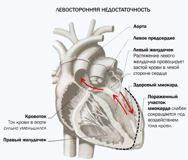 Недостаточность предсердия. Острая сердечная недостаточность правого желудочка. Левосторонняя острая сердечная недостаточность. Недостаточность сердечная недостаточность левого желудочковая. Острая сердечная недостаточность левого желудочка симптомы.