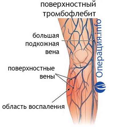 Тромбоз бедренных вен. Классификация тромбофлебита поверхностных вен нижних конечностей. Тромбофлебит глубоких вен нижних конечностей. Тромбофлебит поверхностных вен голени. Острый тромбофлебит поверхностных вен.