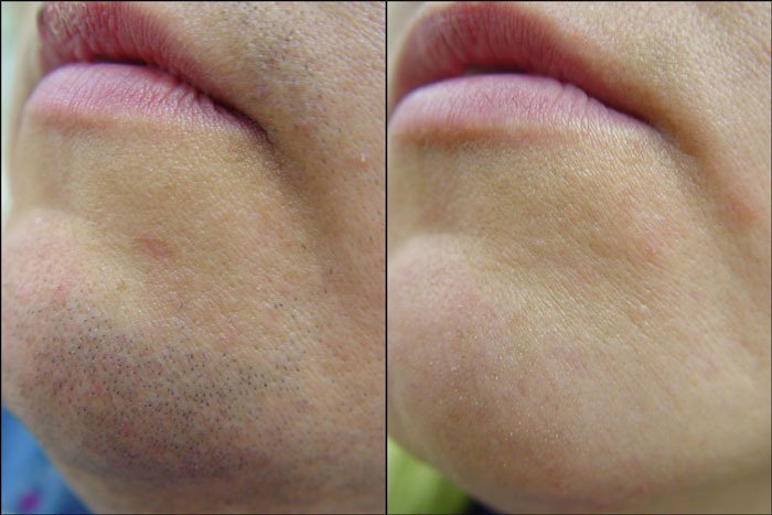 Результат удаление волос муравьиным маслом на лице у женщины