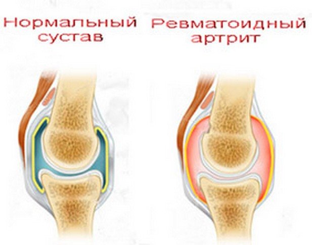 Ревматоидный артрит мышцы. Ревматоидный артрит суставы. Ревматоидный артрит коленного сустава рисунок. Суставная форма ревматоидного артрита.