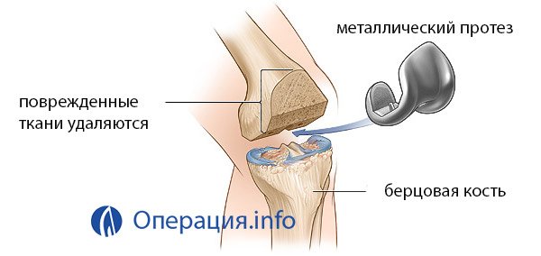 Операция коленного сустава новосибирск