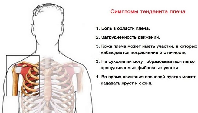Боль в правом плече мышцы