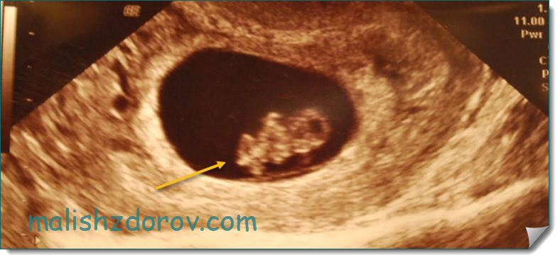 На 8 неделе на данном. 8 Недель беременности фото. УЗИ 8 недель беременности. УЗИ 7-8 недель беременности.
