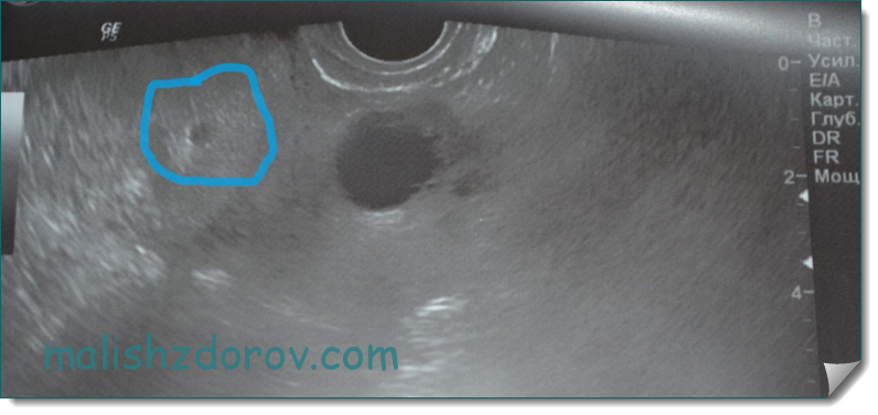 На узи видно внематочную. 4 5 Недель беременности УЗИ внематочная. УЗИ внематочной беременности 3 недели. УЗИ внематочной беременности 4 недели. Внематочная беременность 2 недели УЗИ.