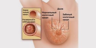 Печіння в грудях у мами після годування: причини і лікування